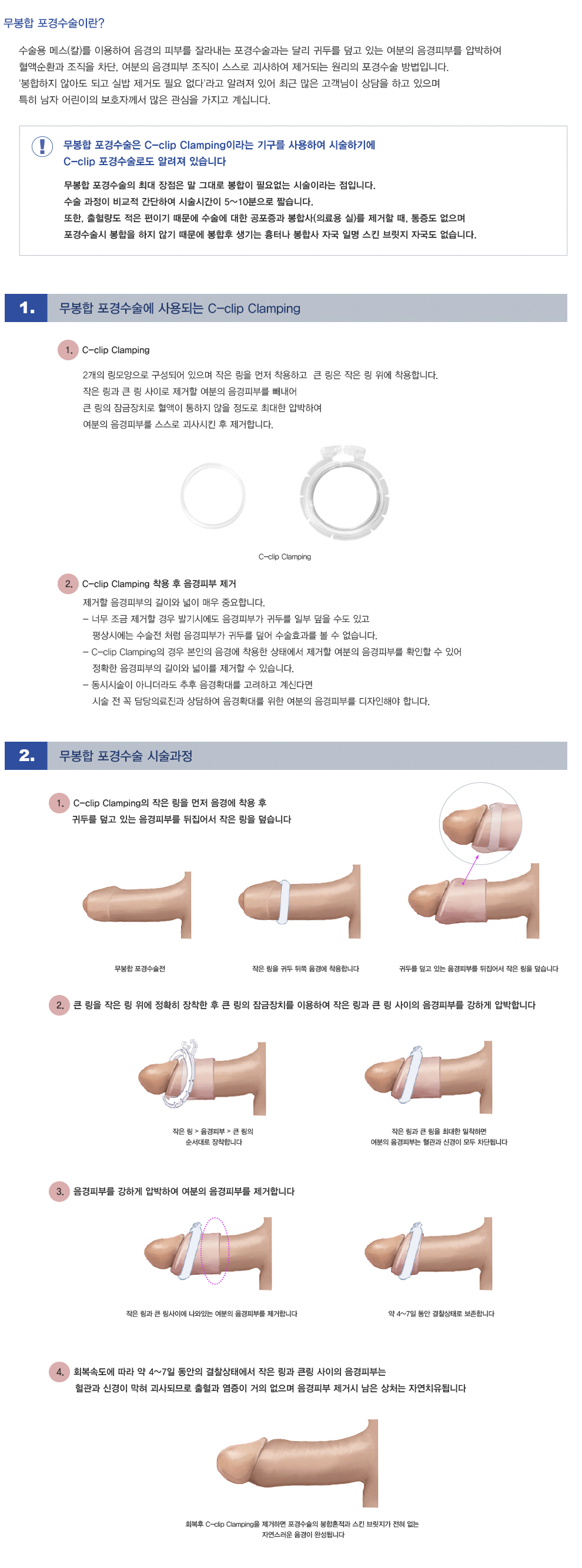 무봉합포경수술
