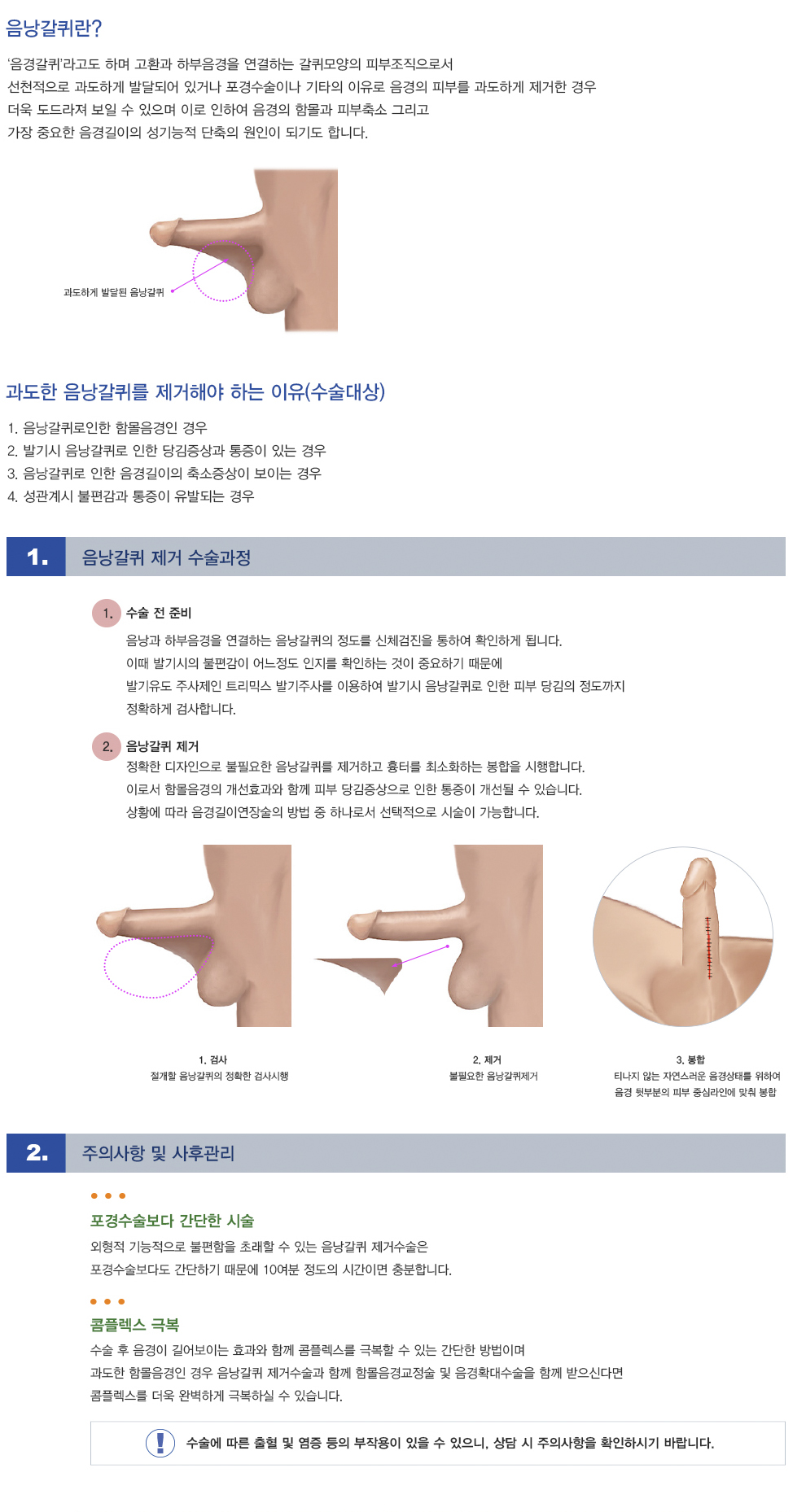 음낭갈퀴 제거술